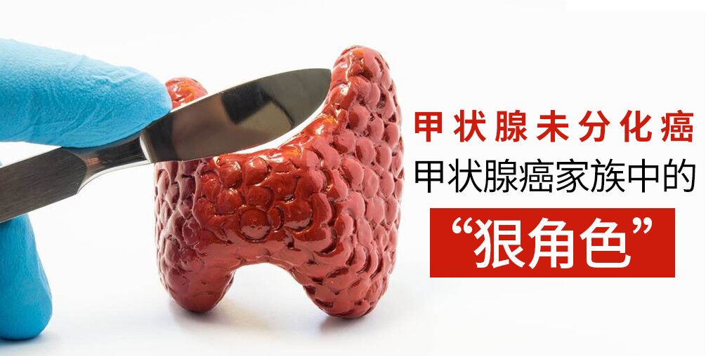別忽視甲狀腺癌，它的家族也有“狠角色”