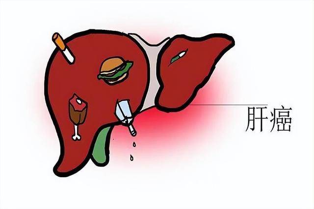 你知道嗎 肝癌都是拖出來的